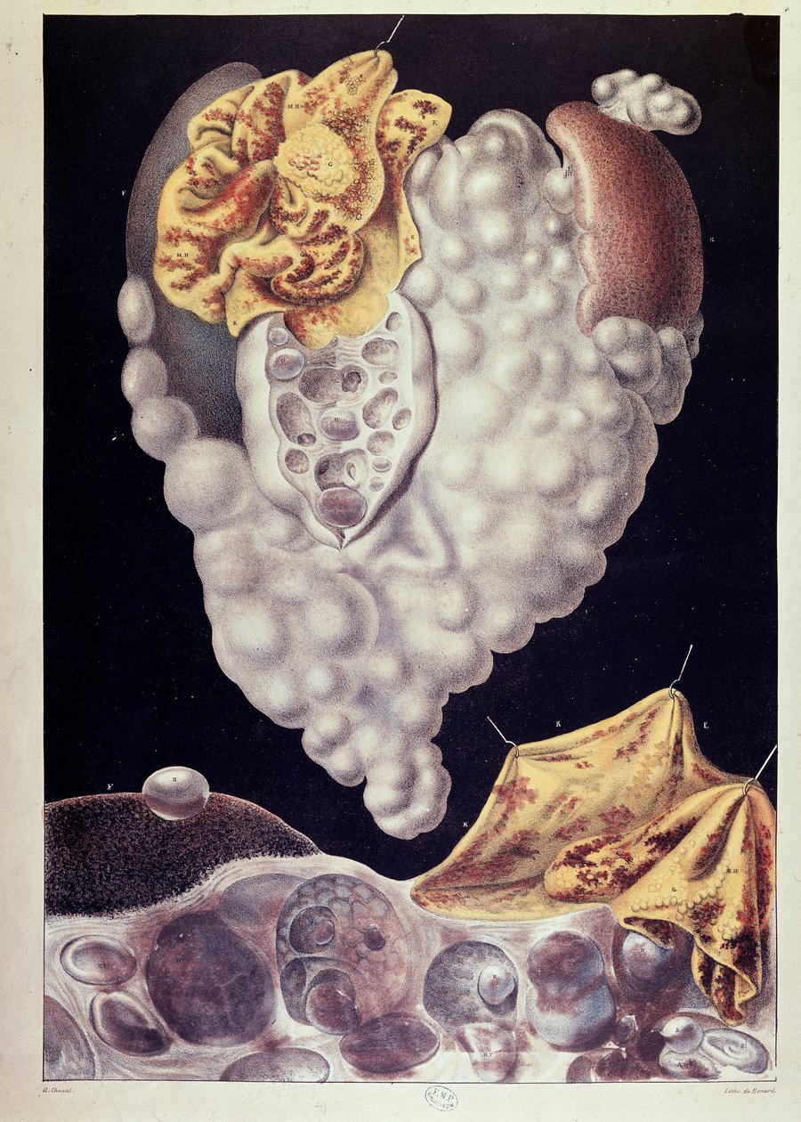 Cáncer - de Cruveilhier de Jean Cruveilhier