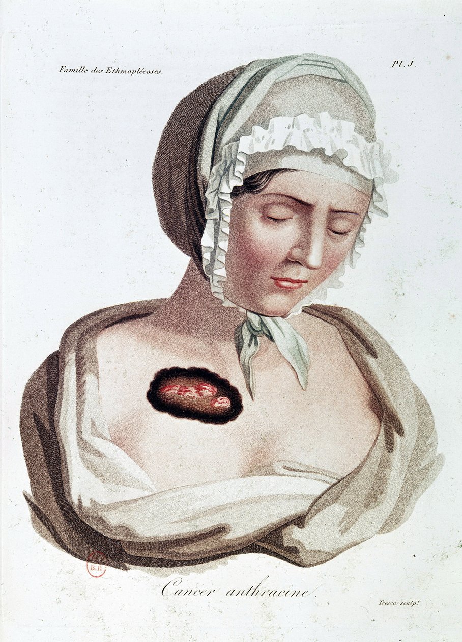 Cáncer de antracita - Alibert, B.N. de Jean Louis Alibert