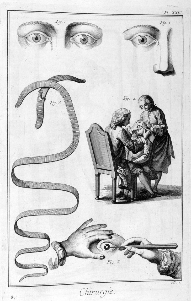 Cirugía ocular, 1751-1777 de Unbekannt