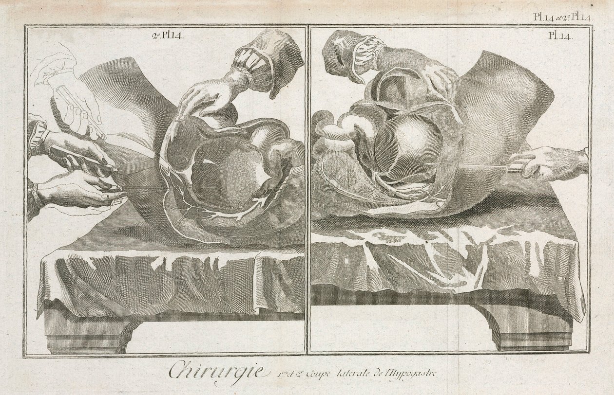 Equipamiento, Cirugía abdominal de la Edad Moderna de Unbekannt