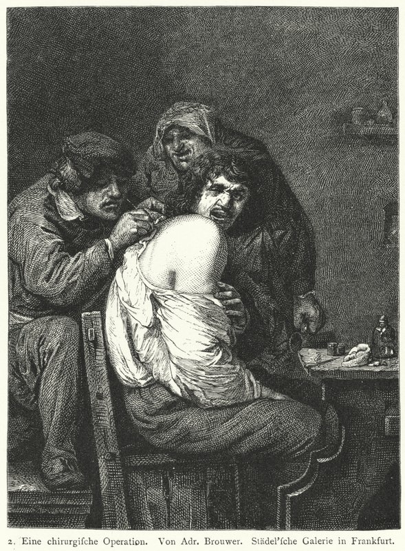 La Operación de Espalda de Adriaen (after) Brouwer